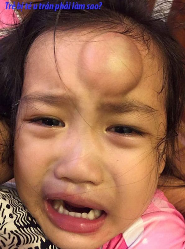 tre bi te u tran phai lam sao 3