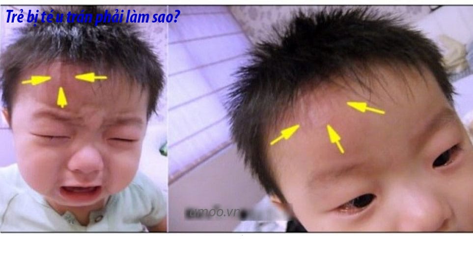 Trẻ bị té u trán phải làm sao, cách xử lí khi bé bị ngã u trán