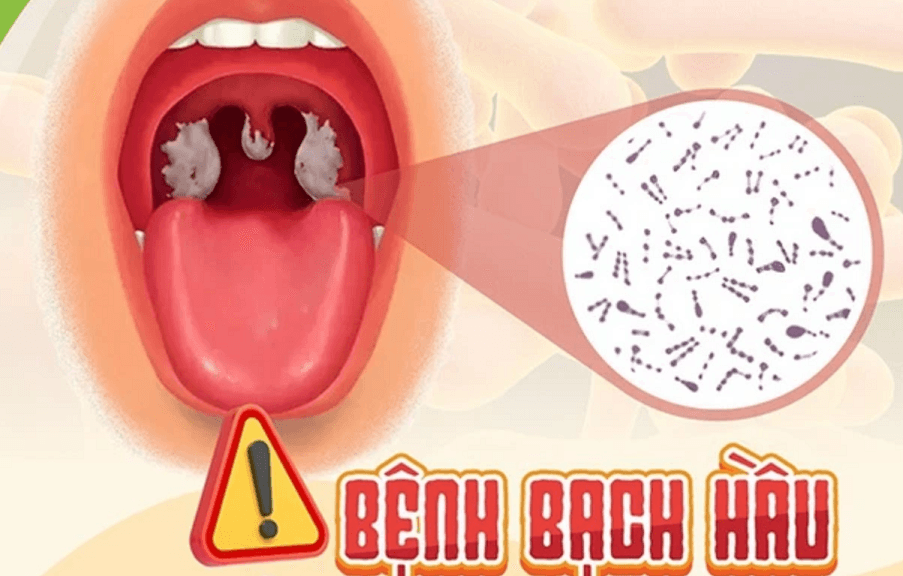 bệnh bạch hầu, dấu hiệu nhận biết và cách phòng tránh bệnh bạch hầu