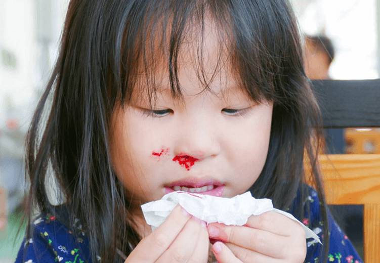 vì sao bé bị chảy máu cam, làm gì khi bé bi chảy máu cam